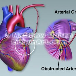 MID CAB Coronary Artery Bypass (image available for licensing)