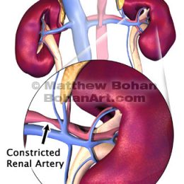 Renal Artery Constriction (Lightwave 3d & Photoshop)