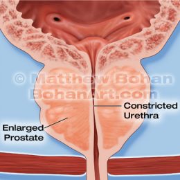 Prostate Gland (Photoshop)