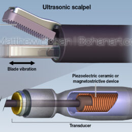 Ultrasonic Scalpel